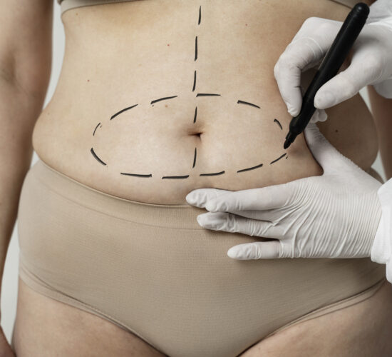 Abdominoplasty