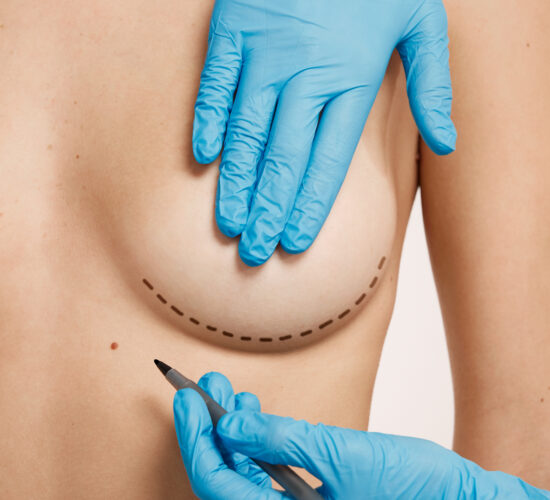 Breast Augmentation